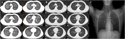 Acute Respiratory Distress Syndrome Caused by Occupational Exposure to <mark class="highlighted">Waterproofing</mark> Spray: A Case Report and Literature Review
